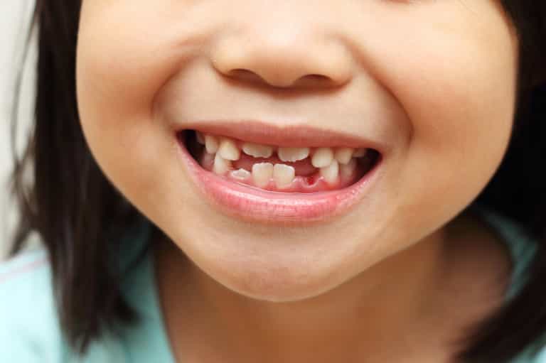 Chemical exposure in pregnancy shows up in baby teeth (and there is a scary link to autism too) Chemical exposure in pregnancy shows up in baby teeth (and there is a scary link to autism too)