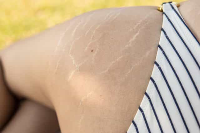 This amazing tattoo artist is covering stretch marks with skin-coloured ink