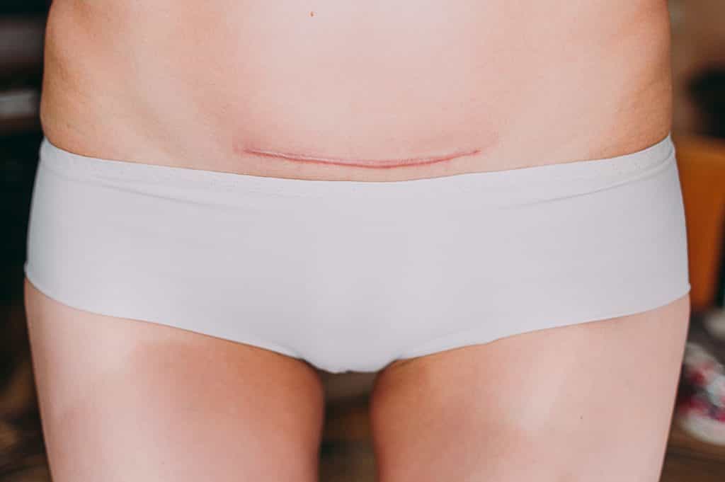 Mum recalls how she had to catch her own intestines after c-section scar burst