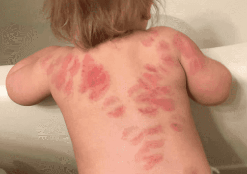 Mum’s horror at finding at least 25 bite marks on daughter’s body after picking her up from nursery