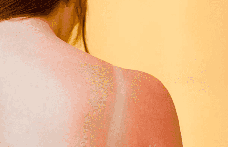 Got some sun yesterday? An Irish pharmacist shares the best ways to heal sunburn