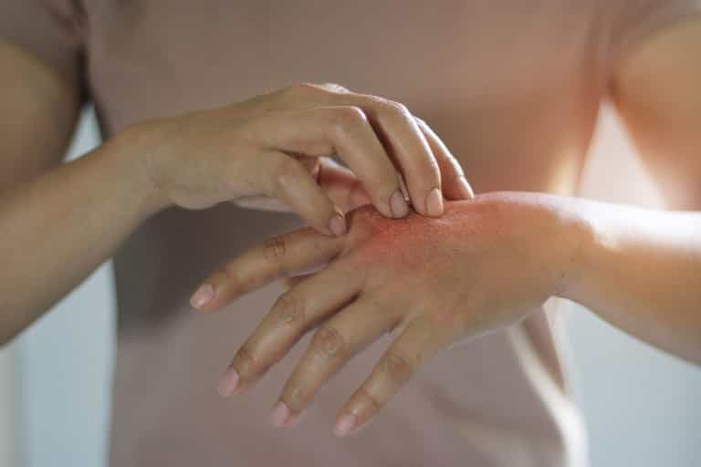 Psoriasis Awareness Month: Top 10 questions about the skin condition answered