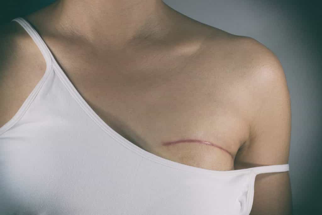 Breast cancer awareness: the 10 most Googled questions (and answers) about the disease