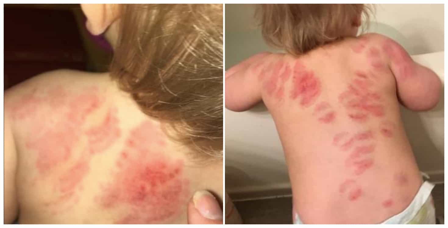 Horrified mum discovers her toddler is covered in bitemarks after a day in creche