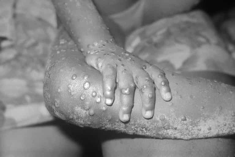 Only a matter of time before monkeypox spreads to Ireland