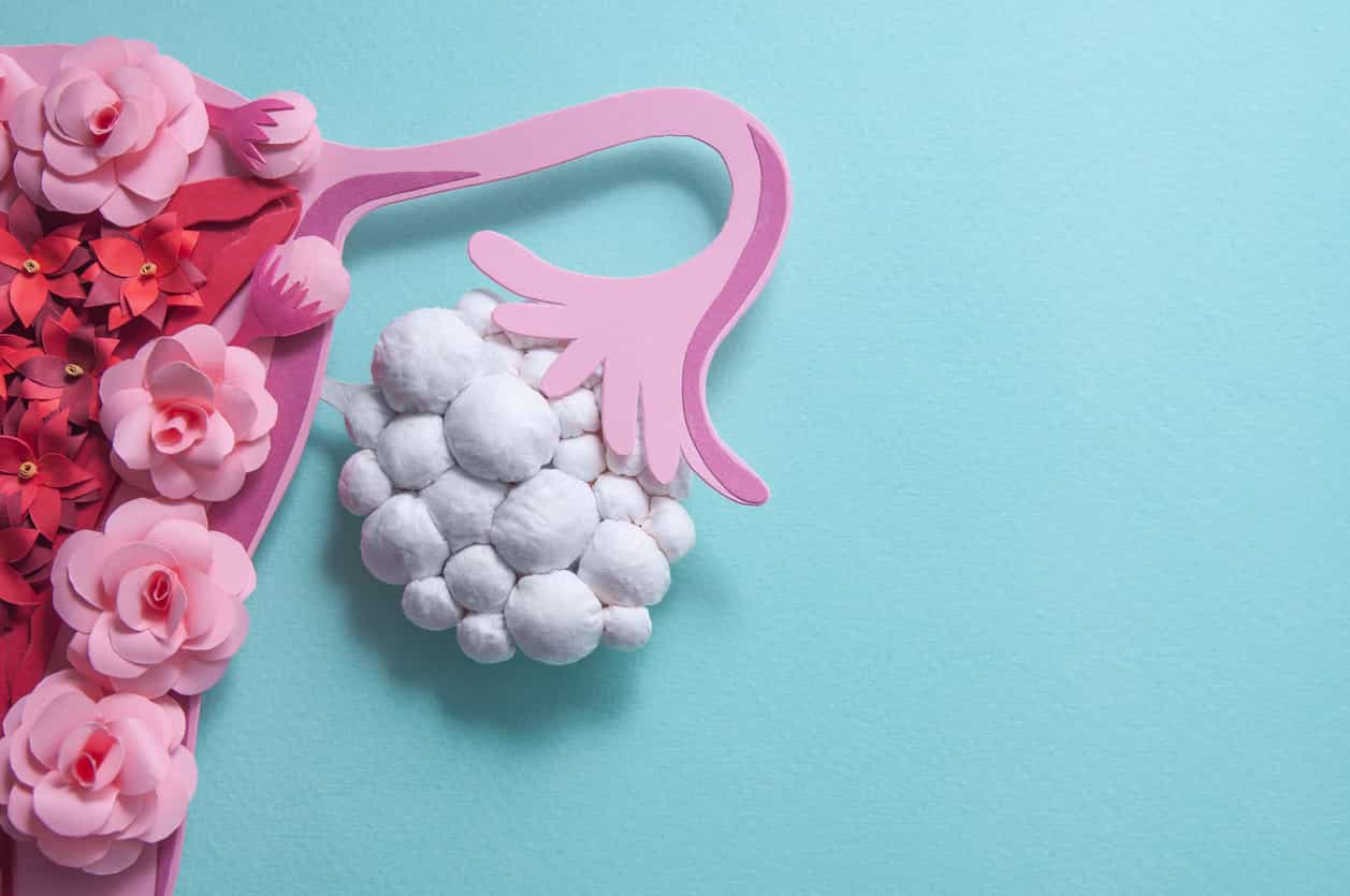 5 things all women should know about Polycystic Ovary Syndrome (PCOS)