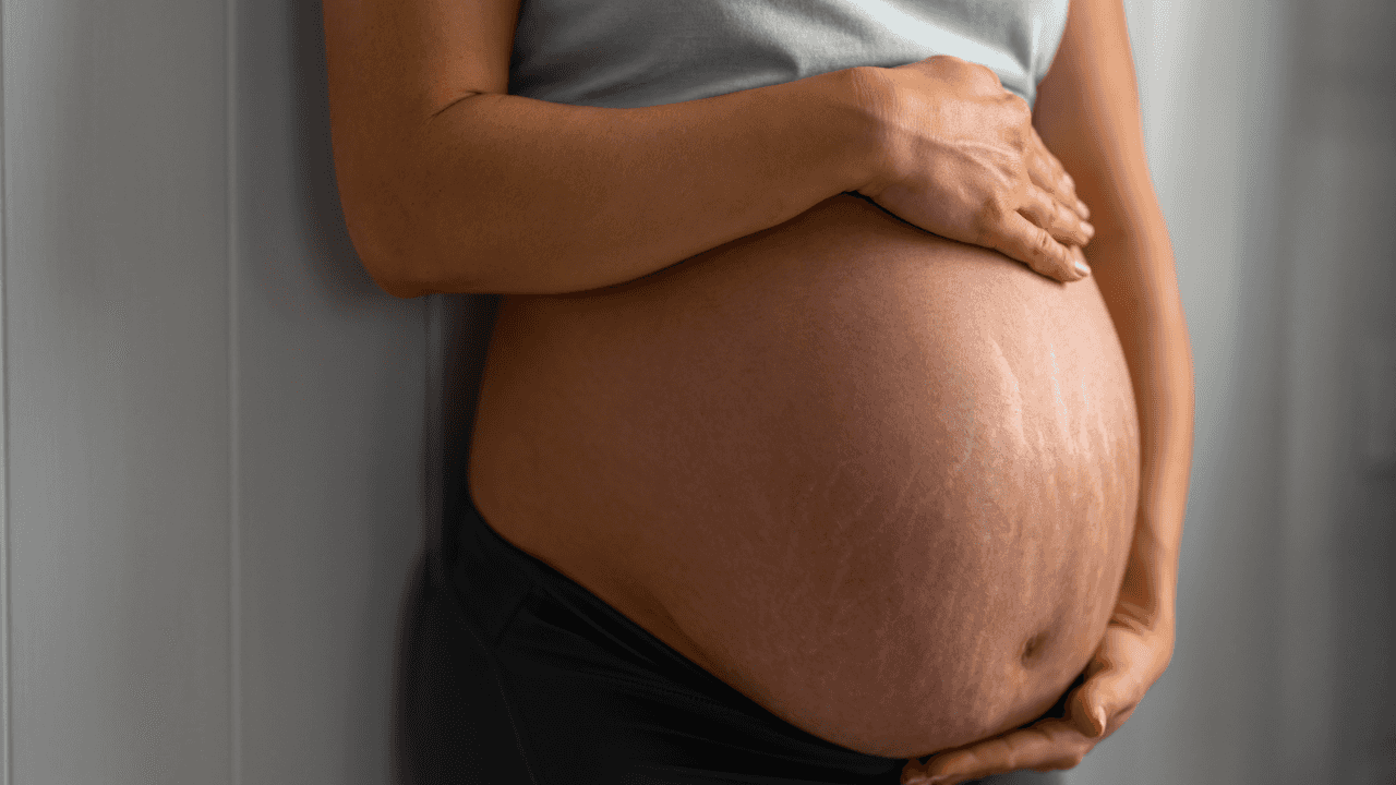 Can you prevent stretch marks in pregnancy?