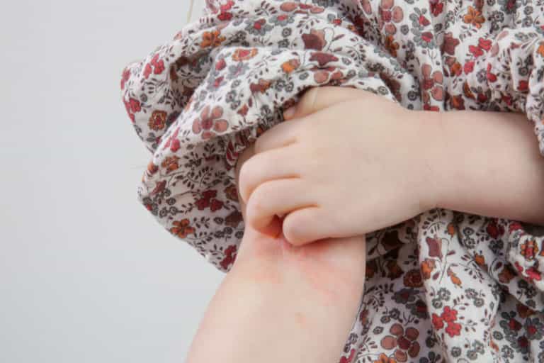 The signs of scabies to beware of as cases triple in one year