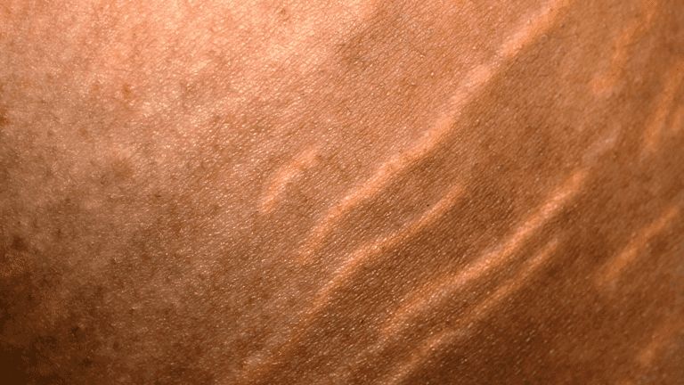 ‘The results can be amazing’ – Irish aesthetician explains how to treat stretch marks
