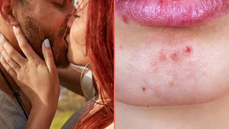 Expert issues grim warning to anyone who kisses bearded men
