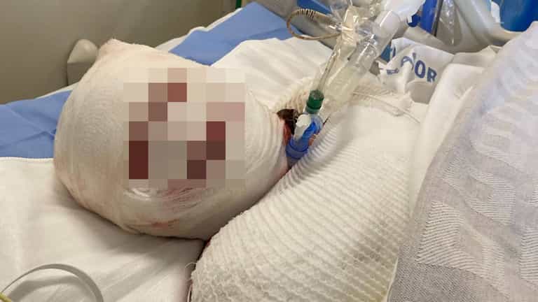 Woman’s face ‘falls off’ after horrific reaction to taking ibuprofen