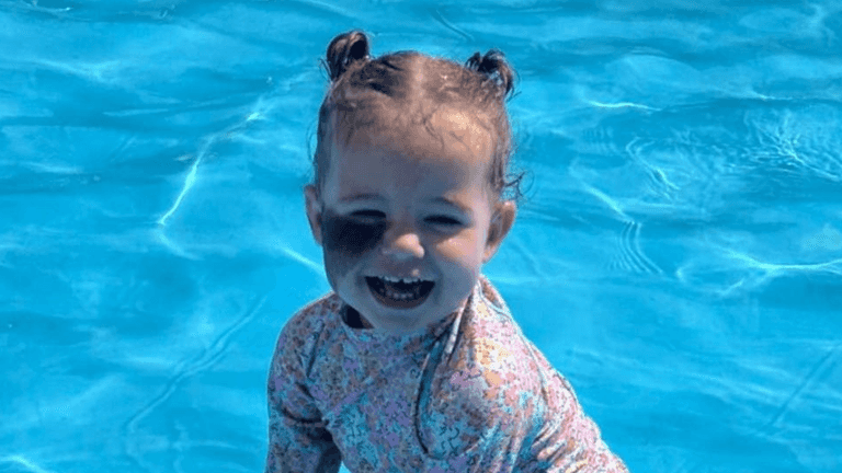 Mum lasering off daughter’s birthmark to ‘protect her’ as she gets older
