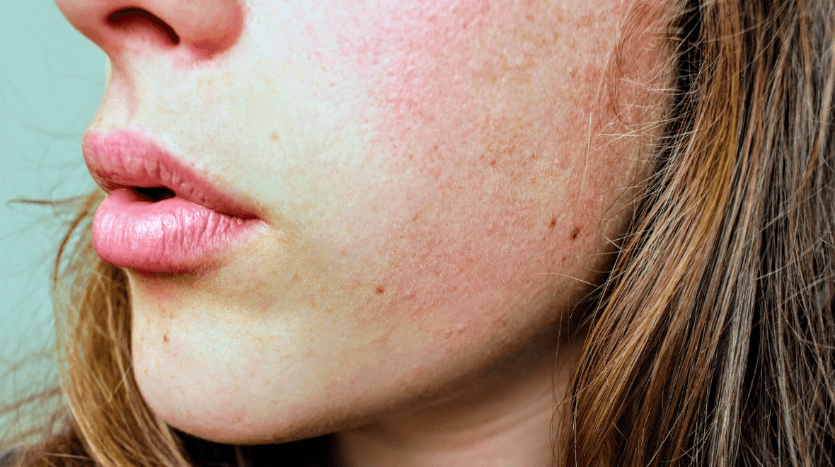 This is one of the top-selling moisturisers in Ireland and it’s perfect for redness