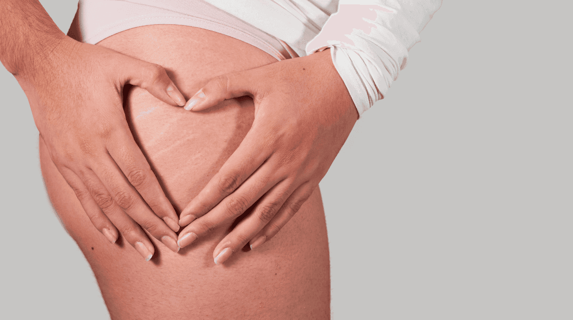 Irish aesthetician explains key to treating stretch marks effectively