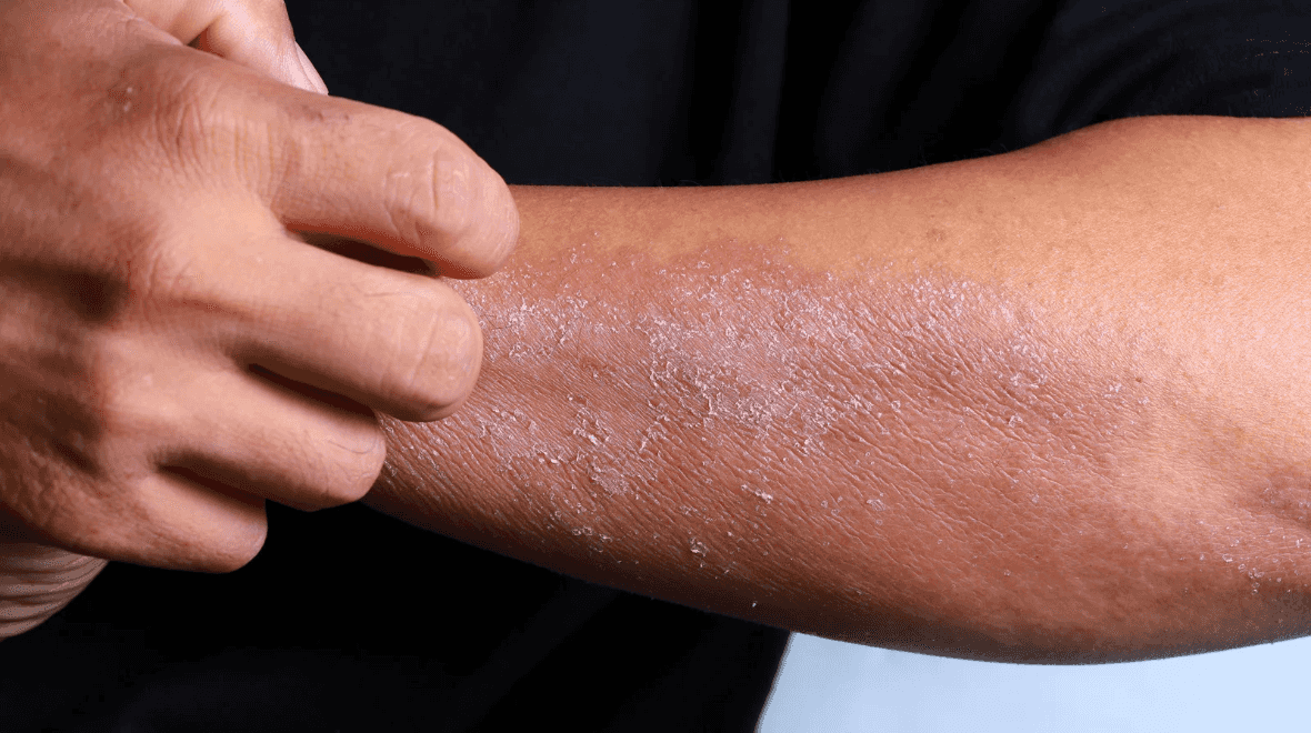 Everything we know about new eczema treatment developed at Trinity College