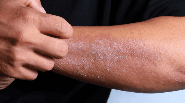 Everything we know about new eczema treatment developed at Trinity College