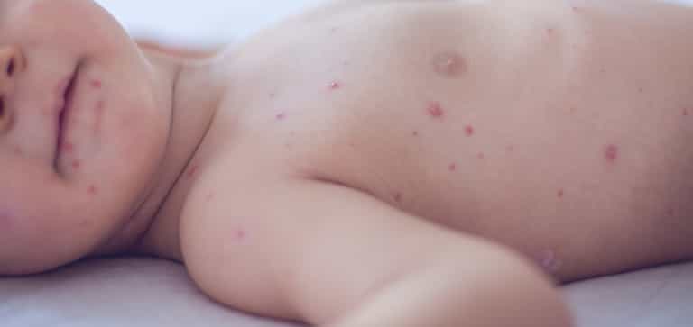Measles outbreak in Donegal spreading with at least seven confirmed cases Measles outbreak in Donegal spreading with at least seven confirmed cases