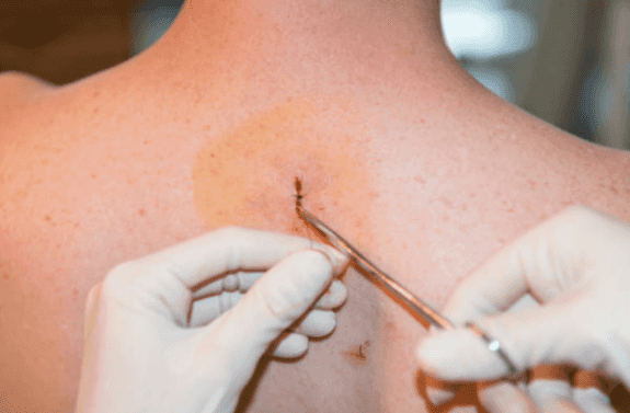 “I never thought it would be cancer”: Stage 4 melanoma patient recalls receiving her diagnosis