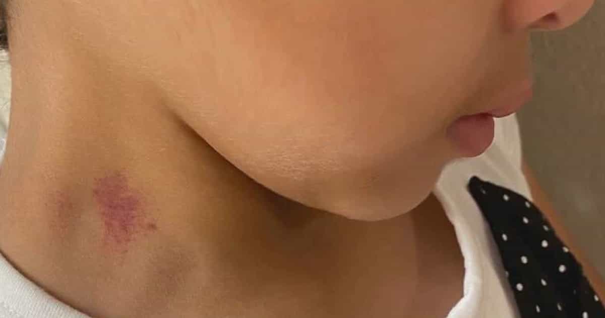 Mum shocked to find hickeys on bullied 6-year-old’s neck after school
