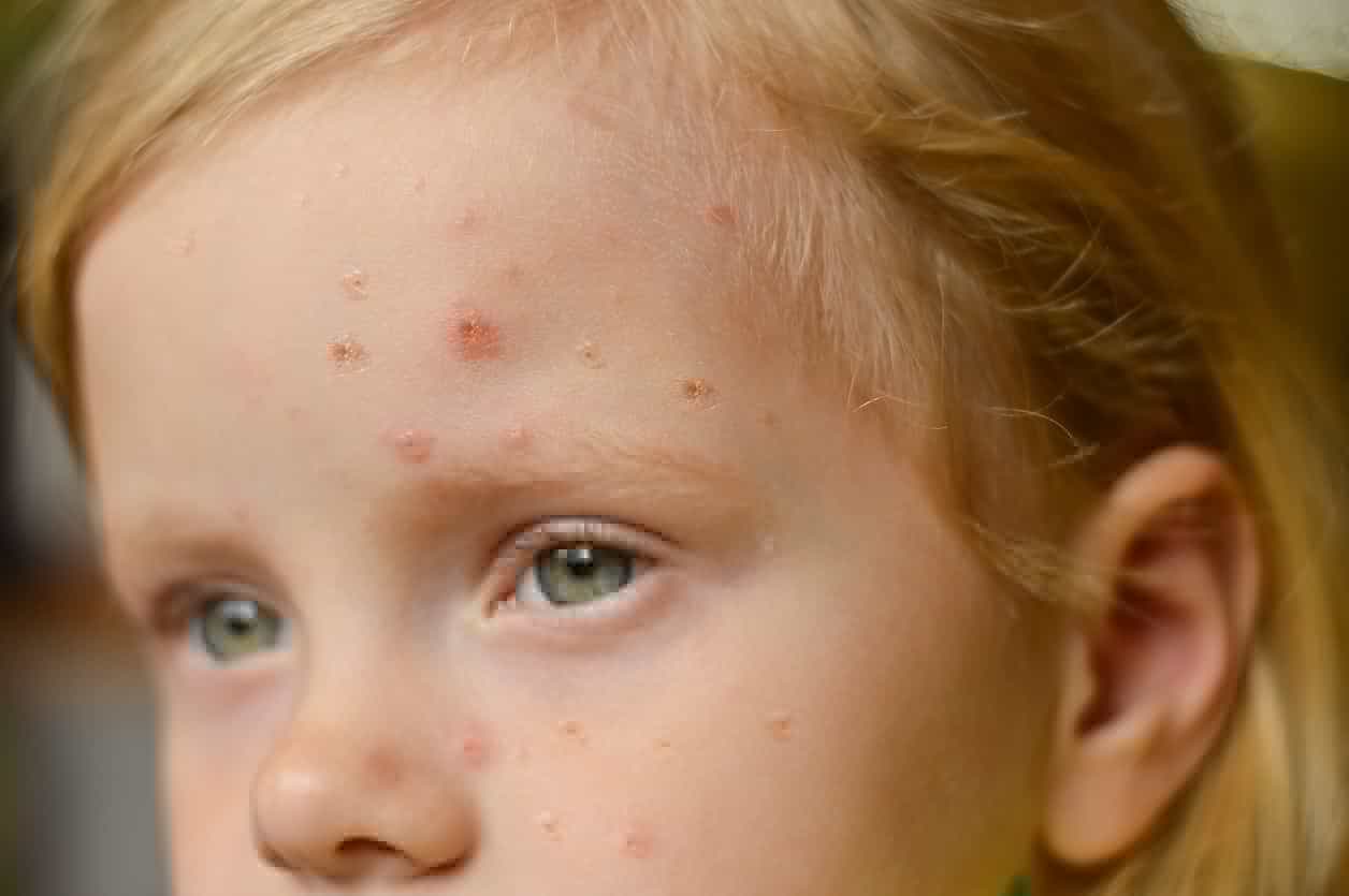 16 people have died from invasive Strep A since October, HSE confirms