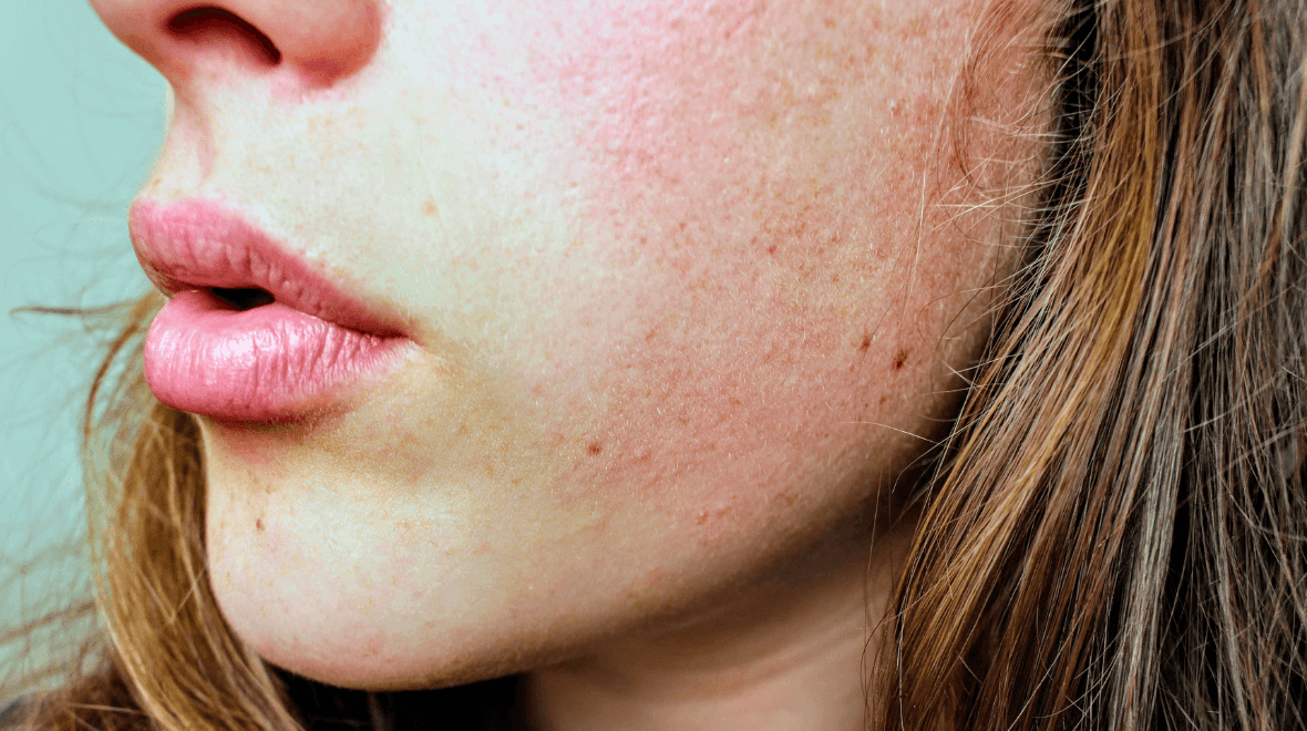 This is one of the best serums to use if you suffer from redness