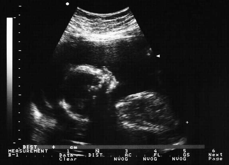 A Galway mum says her baby died… because she wasn’t given a scan