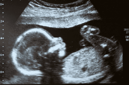 People are getting their ultrasound scans painted onto their nails