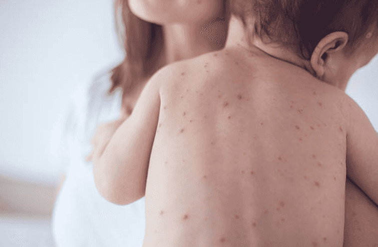 The HSE has confirmed a measles outbreak in Dublin City