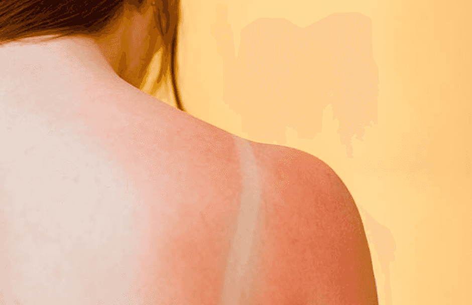 Mum claims her 30-minute shaving foam hack will help get rid of sunburn