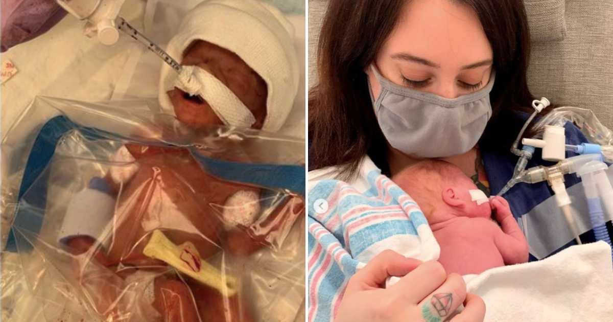 Premature baby born at 22 weeks was initially saved by a plastic bag