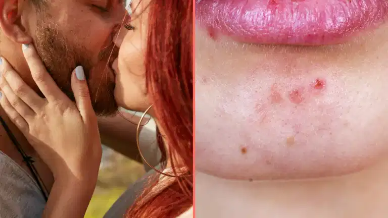Expert issues grim warning to anyone who kisses bearded men