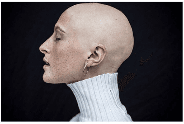 Stunning Irish model with alopecia covers magazine totally hair-free