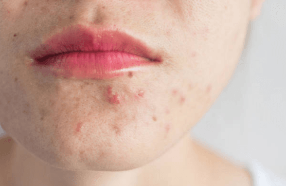 6 steps for treating acne in adulthood, according to a skin therapist