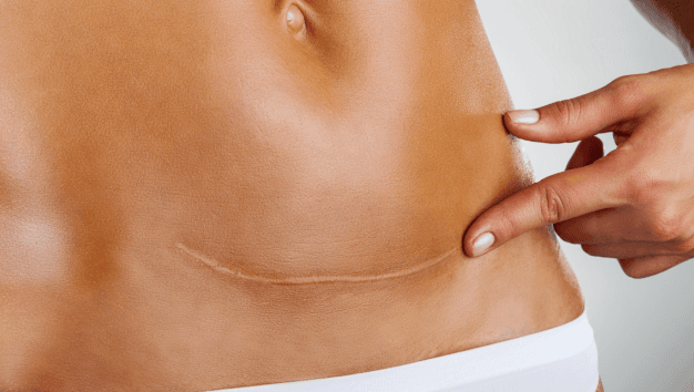 C-section shaming is a thing – and if it has happened to you, you will feel this
