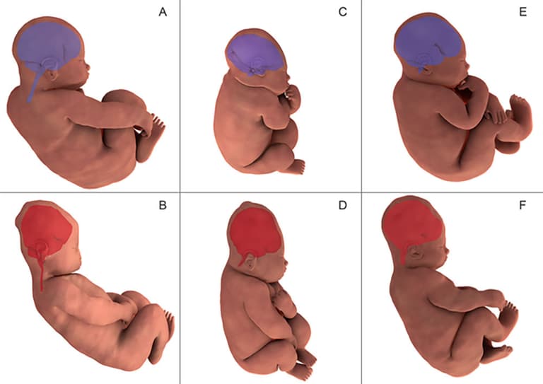 Women give birth in MRI to show baby’s head change shape in labour