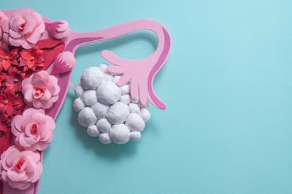 5 things all women should know about Polycystic Ovary Syndrome (PCOS)
