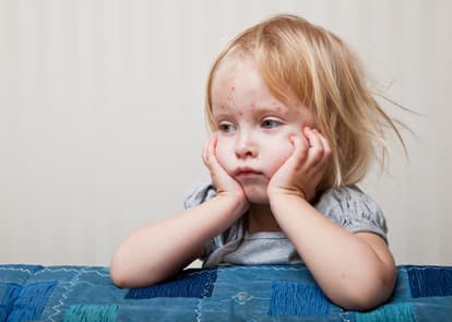 The signs of chickenpox to look out for in kids ‘before the rash appears’