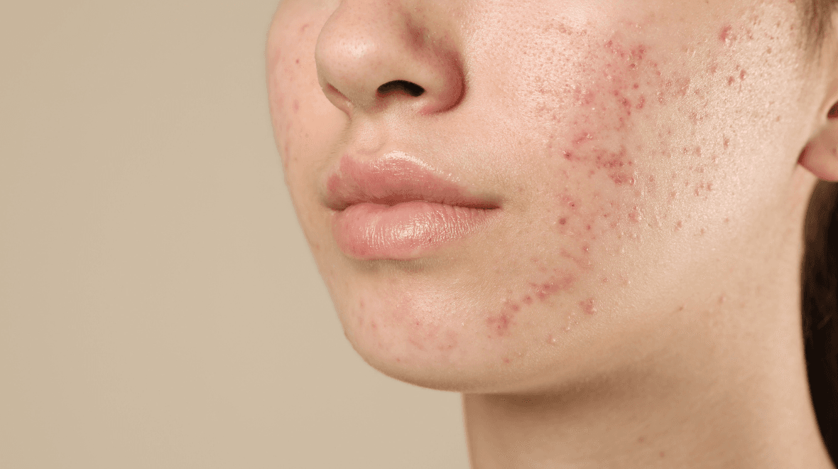 ‘I’m a dermatologist and I swear by this one thing for fading scars’