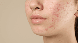 ‘I’m a dermatologist and I swear by this one thing for fading scars’