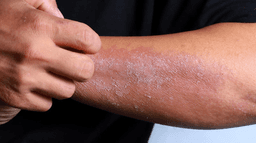 Everything we know about new eczema treatment developed at Trinity College