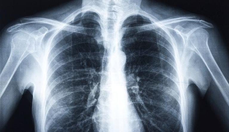 Hundreds of patients recalled after X-ray errors