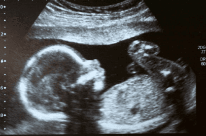 People are getting their ultrasound scans painted onto their nails