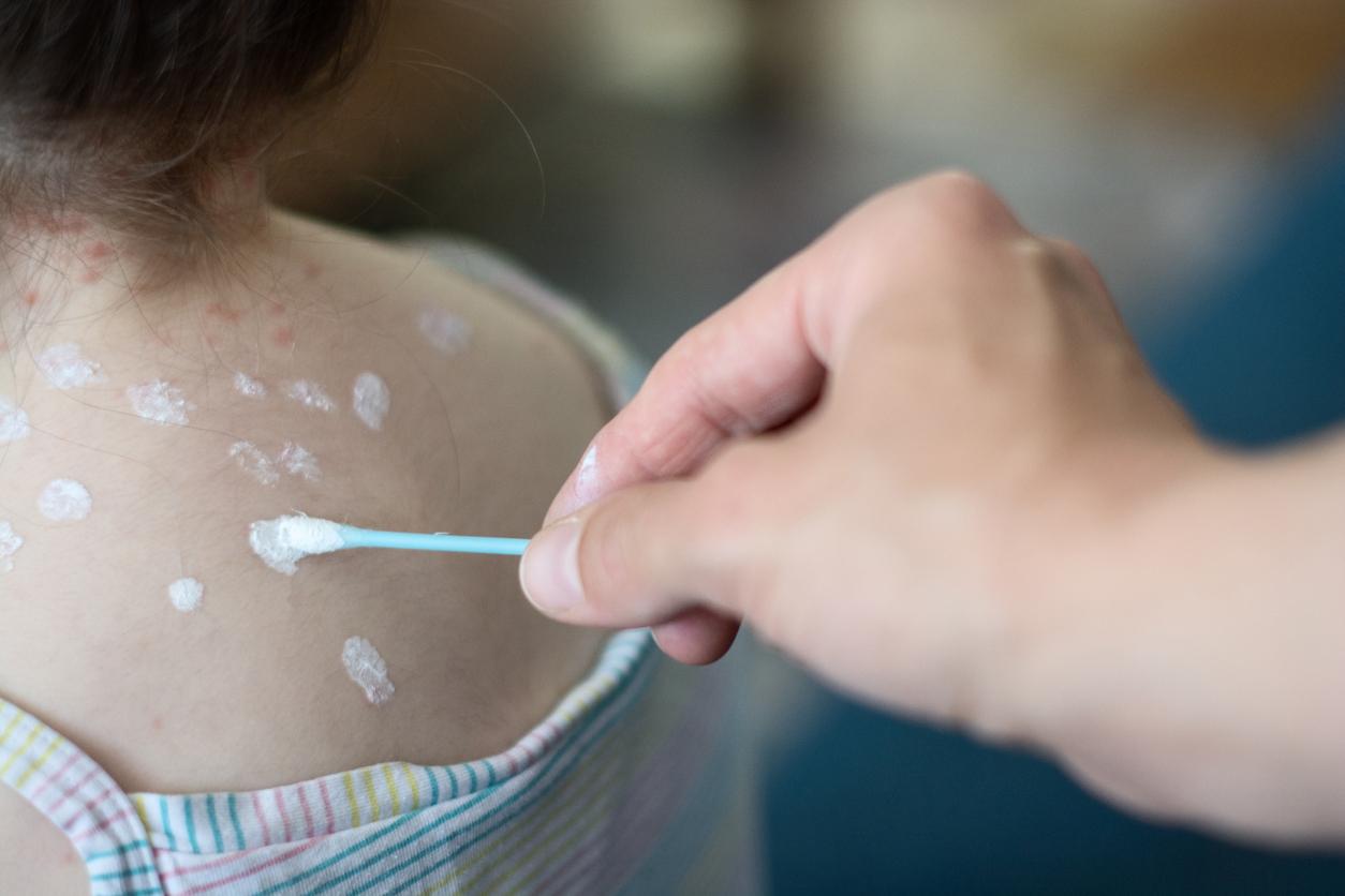 Parents urged to avoid hosting ‘chicken pox parties’ for children