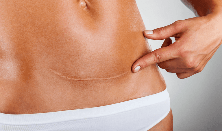 C-section recovery: We asked C-section mums to share their best tips and tricks