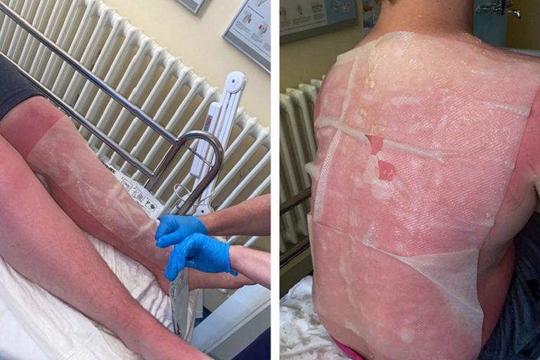 “I am burning from the inside out”: Mum issues stark warning after son suffers extreme sunburn