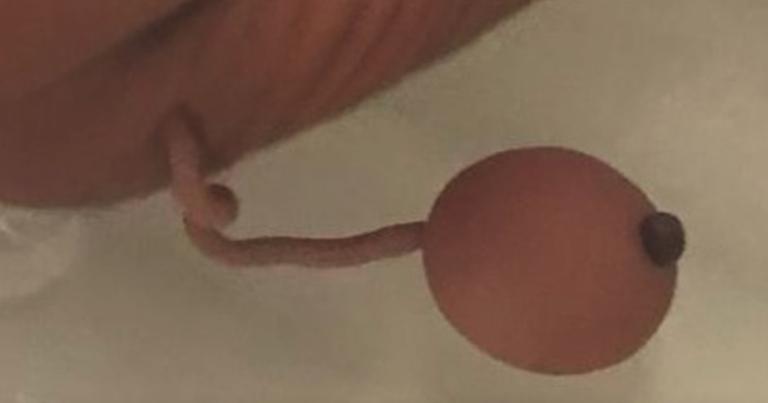 Premature newborn born with human tail