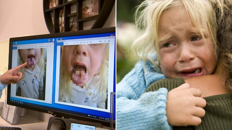 4-year-old girl burns hole in her tongue after eating sour sweets