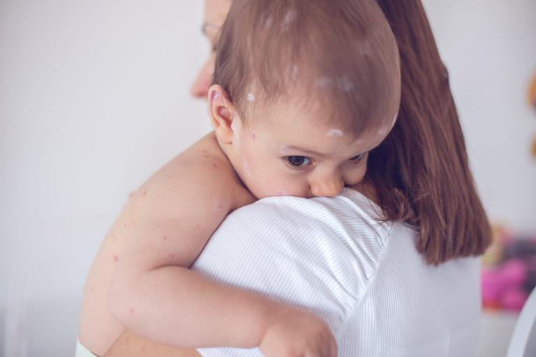 Should you go to work if your child has chickenpox? All you need to know
