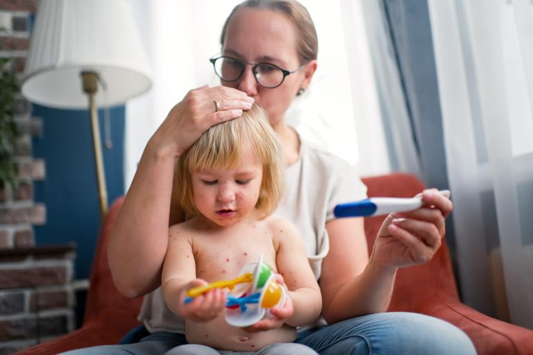 Three lesser known symptoms of Chickenpox in children