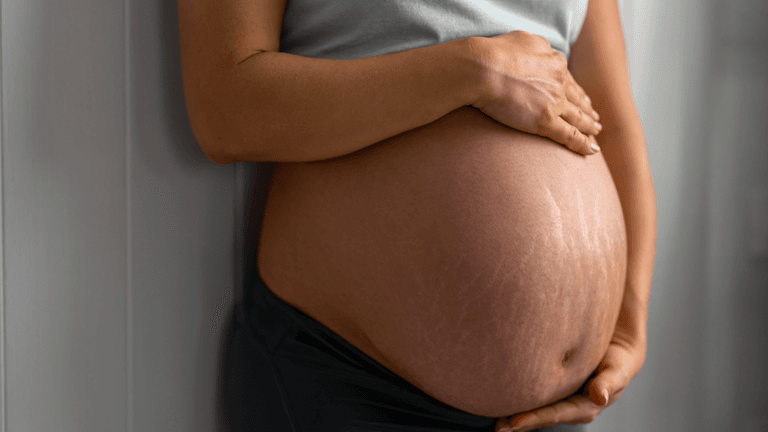 Can you prevent stretch marks in pregnancy?